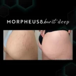 stretchmarks M8
