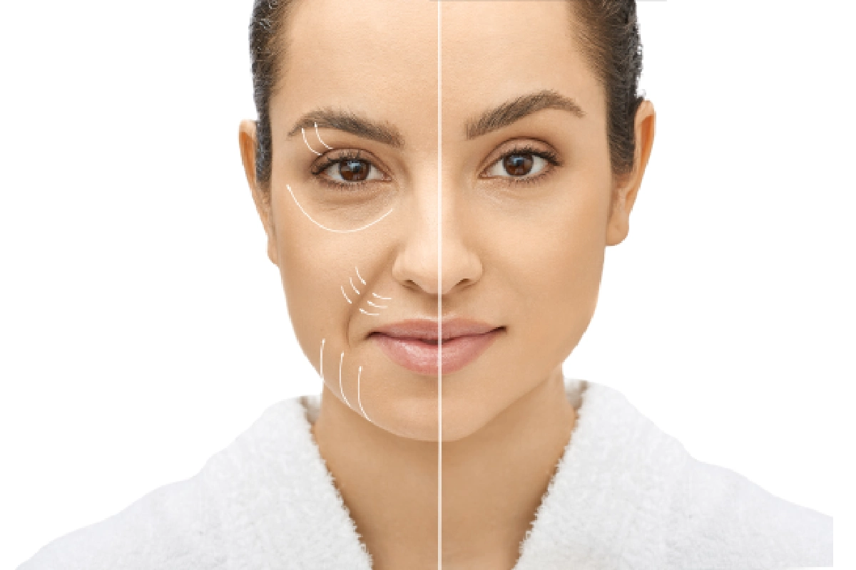 QuantumRF before and after results showing improved skin firmness and reduced facial skin laxity at MICARI Aesthetics & Veins