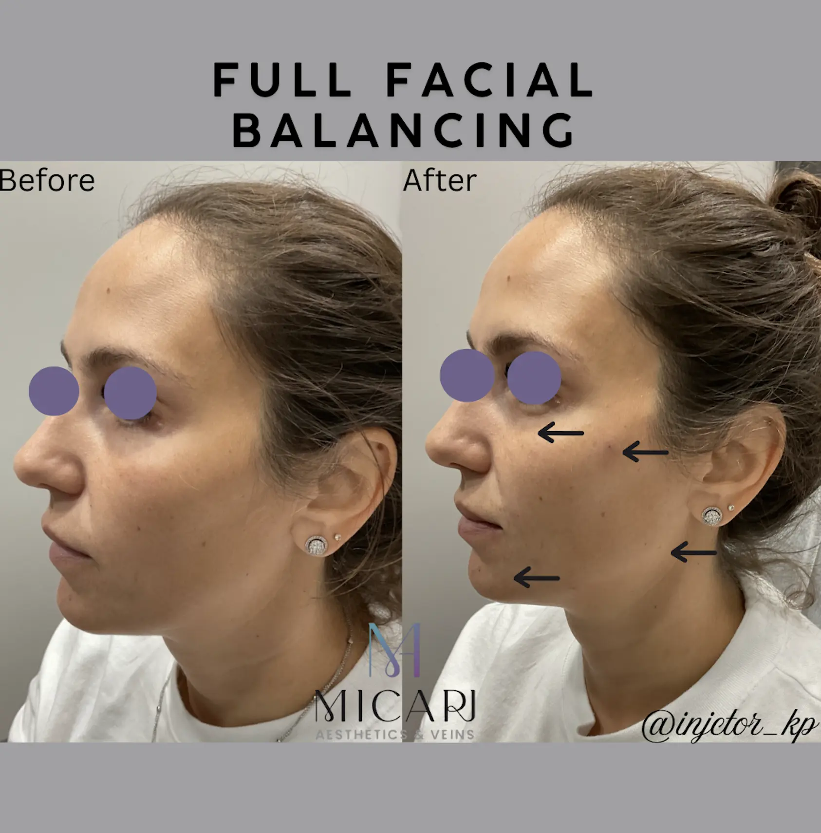 PDO Thread Full Facial Balancing before and after result at Micari Aesthetics Veins in Bellmore, Long Island